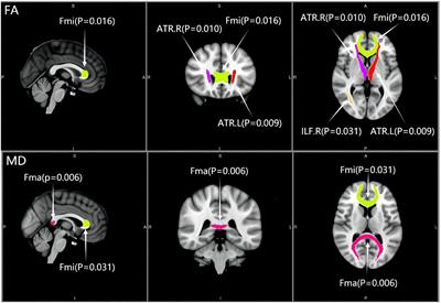 The mean diffusivity of forceps minor is useful to distinguish amnestic mild cognitive impairment from mild cognitive impairment caused by cerebral small vessel disease